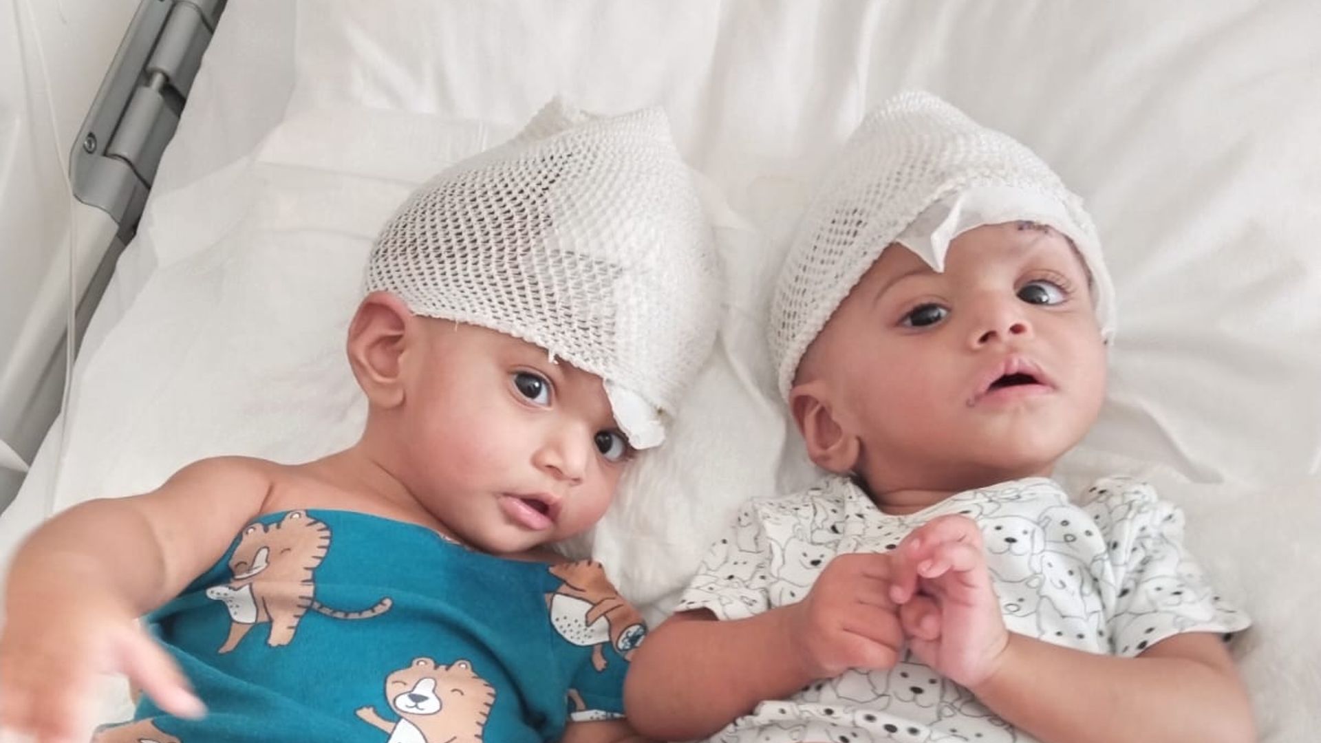 Rare conjoined twin girls separated after 14 hour operation