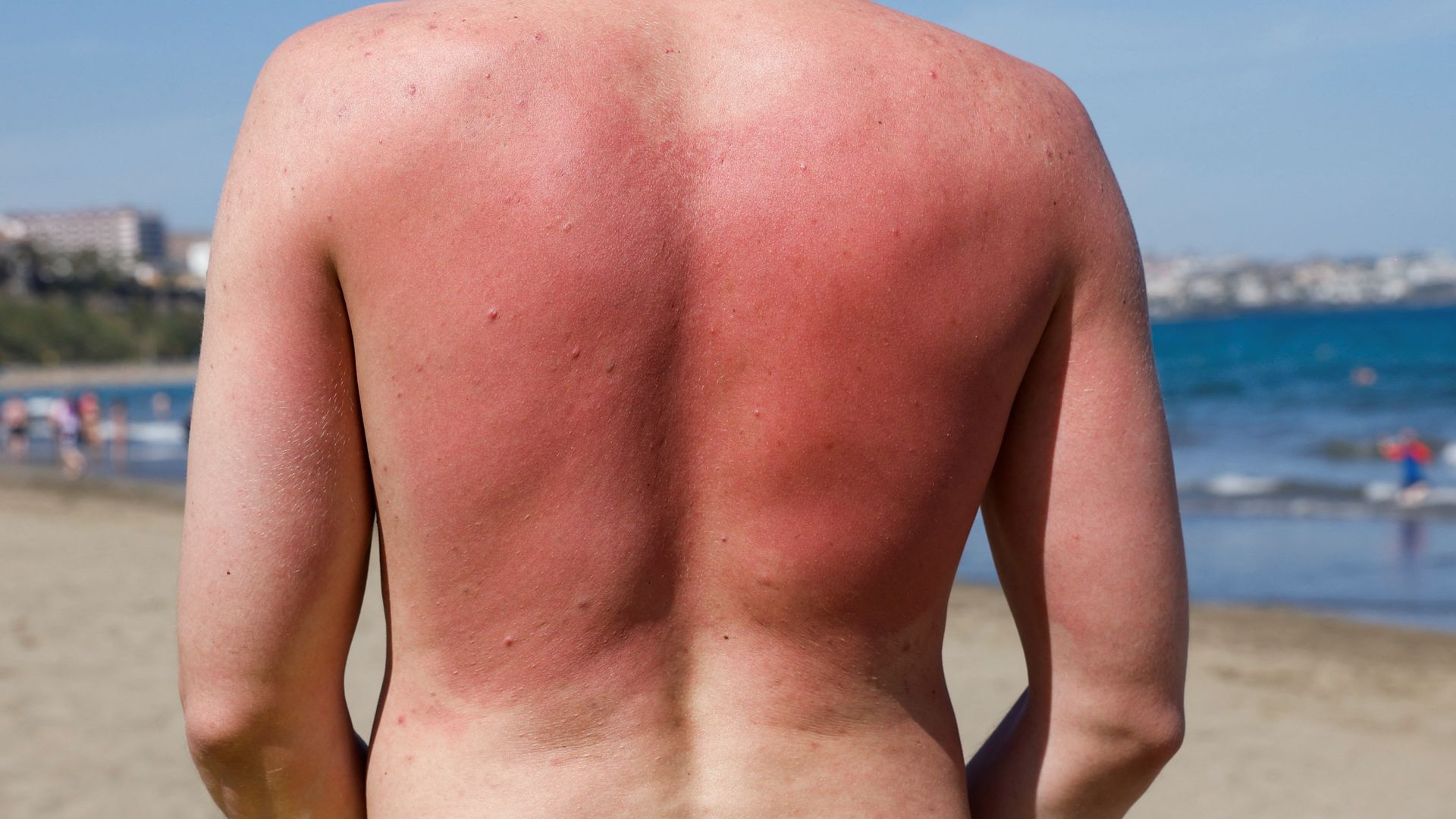 Sunburn isn’t just red skin – here’s what’s happening underneath the burn